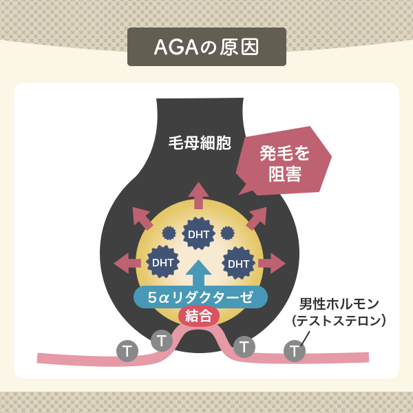 AGAの原因